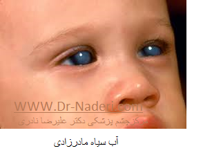 congenital glaucoma آب سیاه مادرزادی