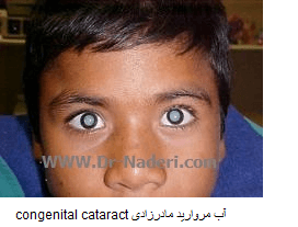 congenital cataract آب مروارید مادرزادی  