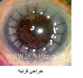 corneal surgery جراحی قرنیه
