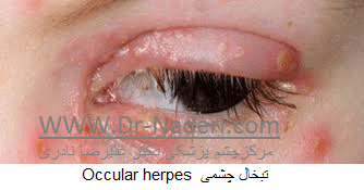 تبخال چشمی Occular herpes