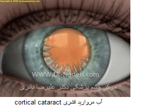 cortical cataract آب مروارید قشری  