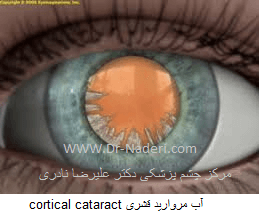آب مروارید قشری cortical cataract 