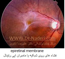epiretinal membrane غشاء های روی شبکیه یا مامبران اپی رتینال 