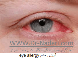 آلرژی چشم eye allergy