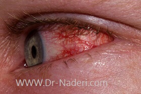 عفونت چشم Eye infections