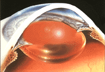 Intraocular fluid جریان مایع داخل چشمی