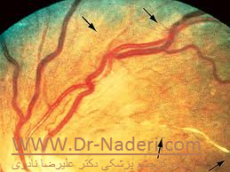 hypertensive retinopathy رتینوپاتی فشار خون