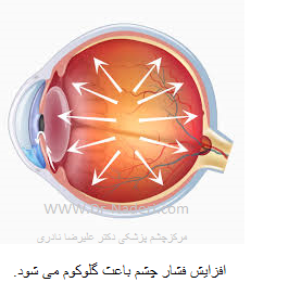 intraocular pressure فشار داخل چشم