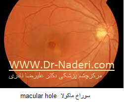 macular hole سوراخ ماکولا 