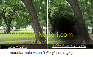 macular hole vsion بینایی در سوراخ ماکولا 