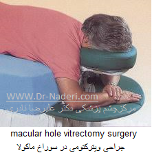 macular hole vitrectomy surgery جراحی ویترکتومی در سوراخ ماکولا 