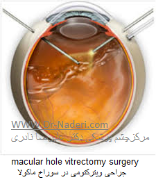 macular hole vitrectomy surgery جراحی ویترکتومی در سوراخ ماکولا 