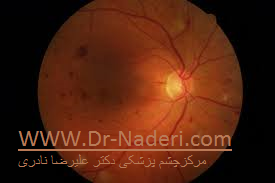 non proliferative diabetic retinopathy رتینوپاتی دیابتی زمینه ای 
