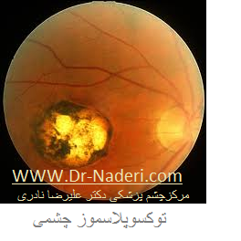 Ocular toxoplasmosis توکسوپلاسمز چشمی