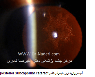 posterior subcapsular cataract آب مروارید زیر کپسولی خلفی 