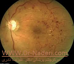 proliferative diabetic retinopathy رتینوپاتی دیابتی پیشرفته 