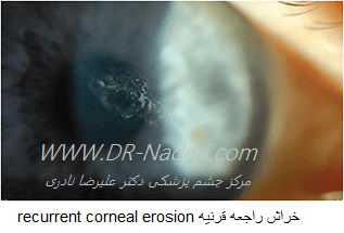  خراش راجعه قرنیه recurrent corneal erosion 