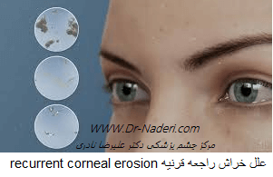  علل خراش راجعه قرنیه recurrent corneal erosion 