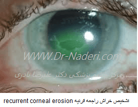 تشخیص خراش راجعه قرنیه recurrent corneal erosion 