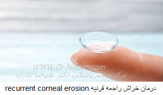 درمان خراش راجعه قرنیهrecurrent corneal erosion 