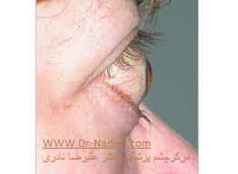 thyroeid eye disease complications عوارض بیماری تیروئیدی چشم