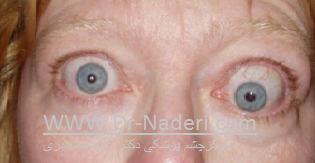 thyroeid eye disease symptom علائم بیماری تیروئیدی چشم 