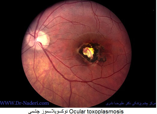 توکسوپلاسمو چشمی ocular toxoplasmosis